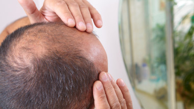 Alopecia- cauze, simptome și tratament