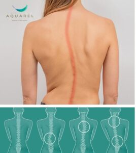 scolioza-aquarel-1024x724