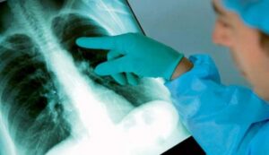 tuberculozaplamani-1464945322