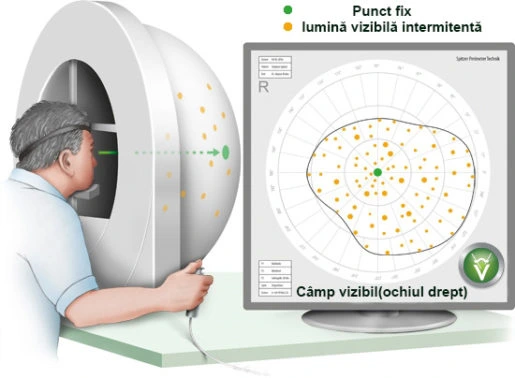 Diagnosticare-glaucom-perimetrie