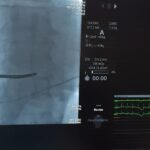 Premieră la Spitalul Județean de Urgență Zalău. Primul defibrilator cardiac implantat cu succes