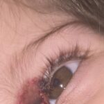 Bebeluș cu arsură de gradul 2 după ce un medic din Jibou i-ar fi scos o căpușă de pe pleoapă cu diluant