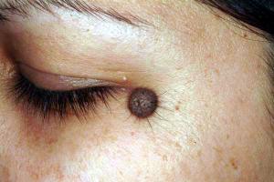 Ziua europeana pentru depistarea melanomului – EURO MELANOMA DAY