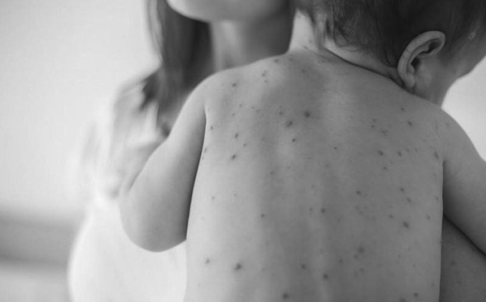 salaj-8-cazuri-de-rujeola0_68055